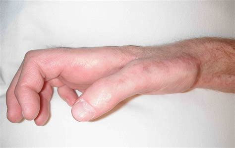 Claw Hand Causes Signs Symptoms Diagnosis And Claw Hand Treatment
