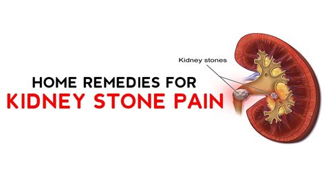Remedies For Kidney Stone Pain Relief Youtube