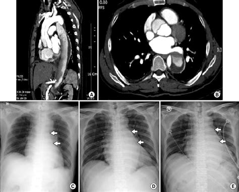 A Preoperative Computed Tomography Revealed A Stanford Type A Aortic