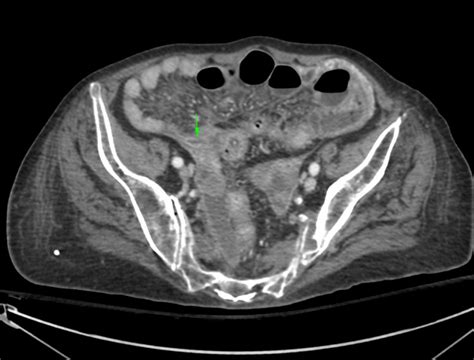 Perforated Appendicitis With An Associated Mucinous Tumour Eurorad