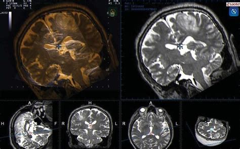 Intraoperative Contrast Enhanced Ultrasound For Brain Tumor Surgery