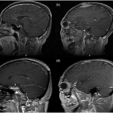 Magnetic Resonance Imaging Scans Of The Patient During Follow Up A