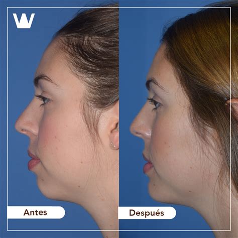 Reduce o aumenta tu mentón y consigue un rostro con mayor armonía. Sin