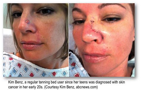 Squamous Cell Skin Cancer Treatment