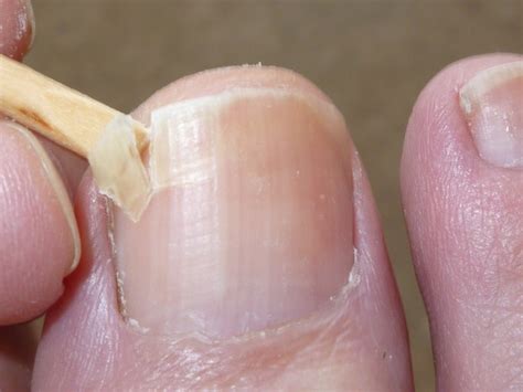 Vertical Split Nail Repair Nails Magazine