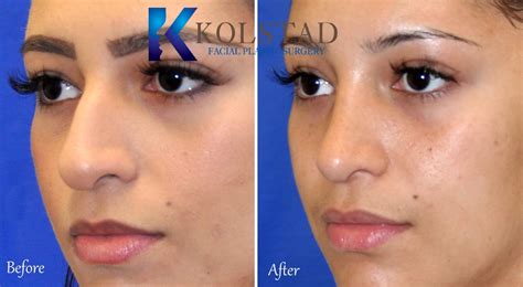 Hispanic Rhinoplasty Before And After Dr Kolstad Facial Plastics
