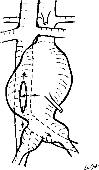 Figure 1 From The Large Spontaneous Aorta Inferior Vena Caval Fistula