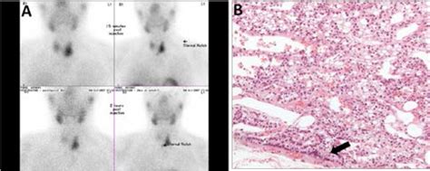 Primary Hyperparathyroidism With Water Clear Cell Content The Impact