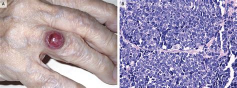 Rare Case Of Merkel Cell Carcinoma Reported In Nejm