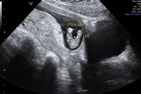 13 Week Ultrasound Gender Reveal Page 1 Babycenter