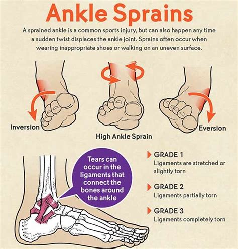 Ankle Sprain Causes Treatment And Prevention Reliva Physiotherapy