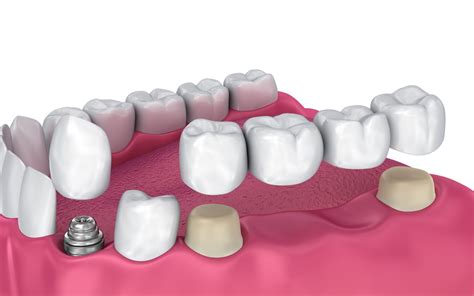 the four types of dental bridges heritage park dental dentist in palo alto ca dr shadi