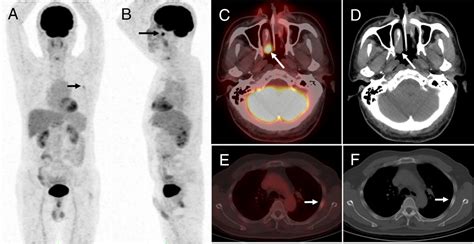 Osteoblastoma Of The Rib Mimicking Lymphomatous Involvement