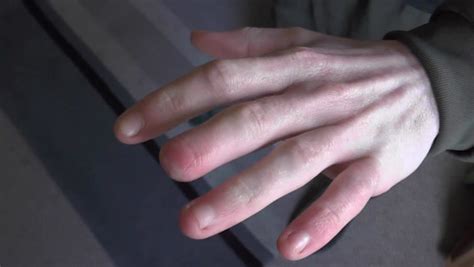 Man Loses Finger Tip On Night Out With No Idea How It Happened But