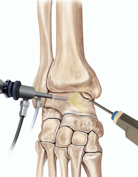 Arthroscopy Of The Ankle Healthdirect