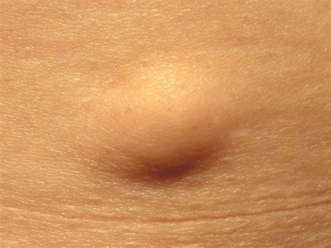 A Lipoma Is A Small Fatty Lump That Grows Under A Persons Skin Lipomas Typically Appear On