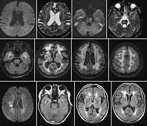 Magnetic Resonance Imaging Of Case Showing Acute Lacunar Infarcts