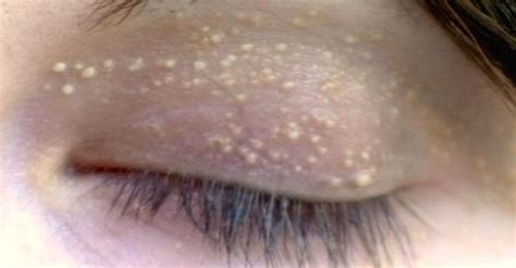 She Had Strange White Bumps On Her Eyelids But Had No Idea Its A Sign