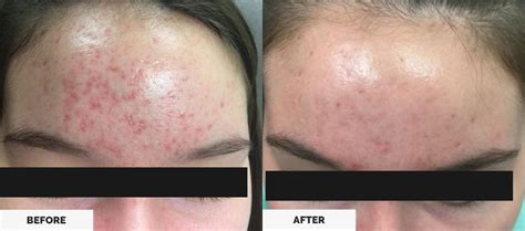 Severe Acne Scars On Forehead