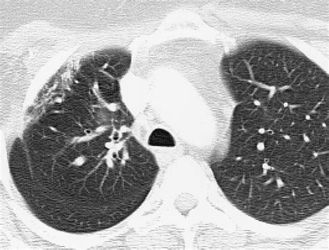 Effects Of Radiation Therapy On The Lung Radiologic Appearances And
