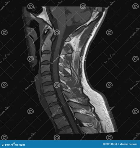 Realistic Image Sagittal Of Cervical Spine With Ct Scan Mri Magnetic