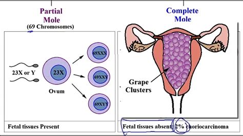 Molar Pregnancy Partial And Complete Hydatidiform Mole Youtube
