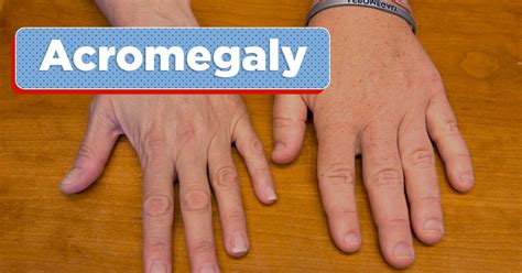 graves disease as related to acromegaly pictures