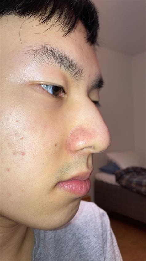 Skin Concerns Why Are The Edges Around My Nose So Red Red Spots All