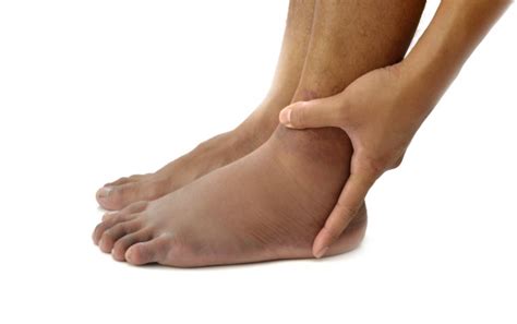 Pitting Edema Vs Non Pitting Edema Whats The Difference Louisville