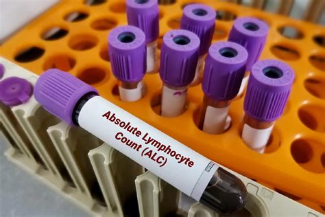 Absolute Lymphocyte Count Test Normal Range Purpose Preparation
