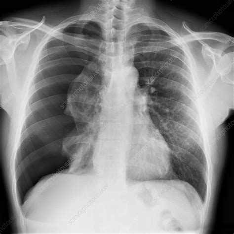 Design a logo, create a website, build an app. Pneumothorax, X-ray - Stock Image - C017/7812 - Science Photo Library