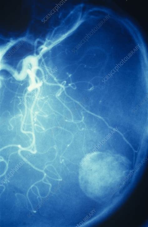 Brain Tumour X Ray Stock Image C0235528 Science Photo Library