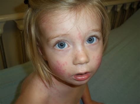 Rash On Toddlers Face Pictures Photos