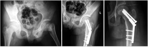 Displaced Femoral Neck Fracture In A Patient Managed With Open