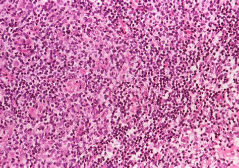Coloured Lm Of Low Grade Non Hodgkins Lymphoma Stock Image M132
