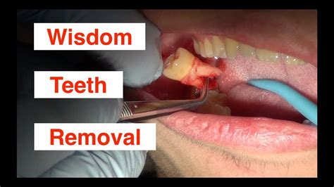 What To Do For Wisdom Teeth Removal Pain