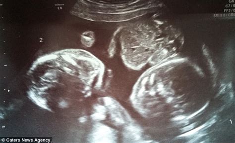 Identical Twins Pictured Cuddling Each Other In The Womb Daily Mail Online