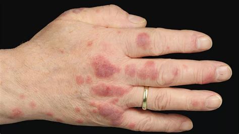 Man Discovers Nasty Red Rash On His Hands And Elbows Is Potentially