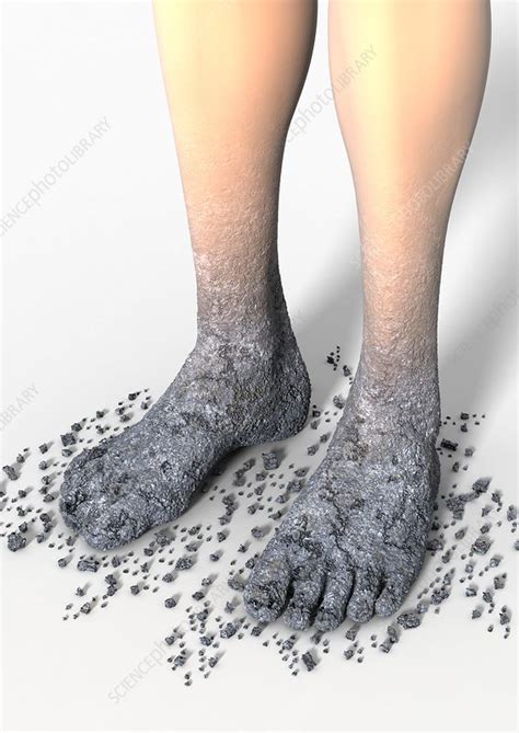 Diabetes-related foot problems, artwork - Stock Image ...