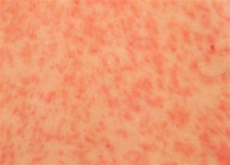 Papular Rash Pictures To Pin On Pinterest Pinsdaddy