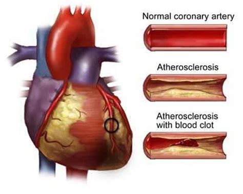 Coronary Artery Disease Allegras Ib Biology