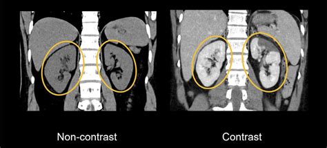 Abdominal CT Basics LITFL Radiology Library