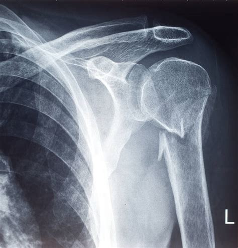 Shoulder X Ray Pictures Images And Stock Photos Istock