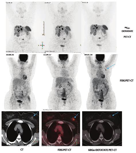 The Last Fluoro 2 Deoxy D Glucose Positron Emission Tomography Computed