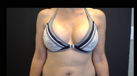 Breast Augmentation Results In A Bikini 400cc Smooth Round Silicone