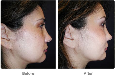 A broad forehead or an exceedingly high hairline can make the features on your face seem out of proportion, unbalanced, or even misaligned. Newport Beach Forehead, & Eyebrow Lift Cosmetic Surgery