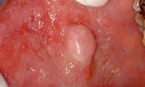 Lump and Bump Removal – Doctor V.