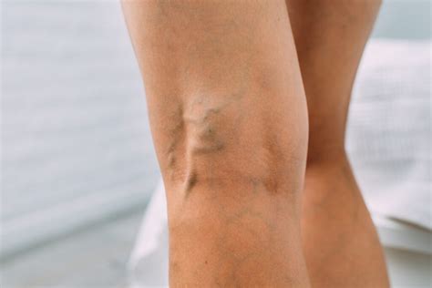 What Causes Veins To Show In Legs Archives The Vein Center Of Maryland