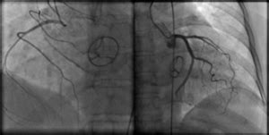 Coronary Angiography Peter Yan Cardiology Clinic
