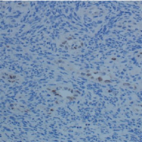Lateral Neck Lymph Node Mass Hande 20x Spindle Cells Neoplastic Cells